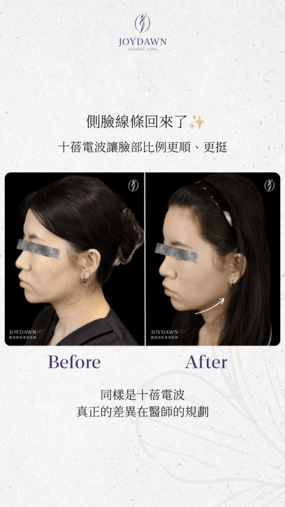 十蓓電波案例 ❶｜改善嘴邊肉，輪廓線更俐落