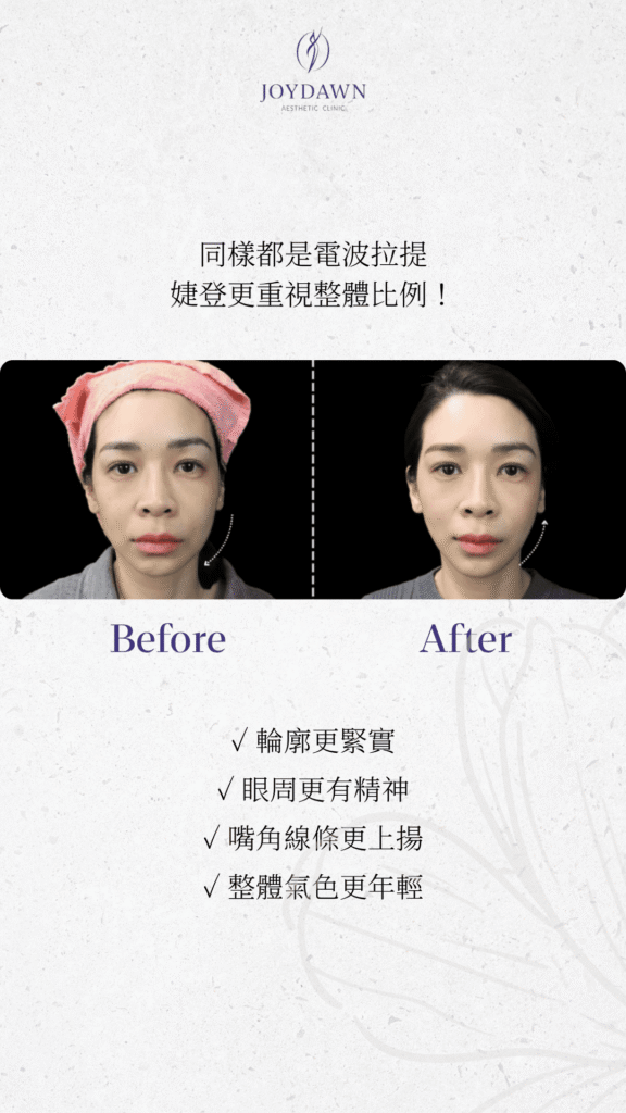 十蓓電波案例 ➋｜改善嘴邊肉，輪廓線更俐落